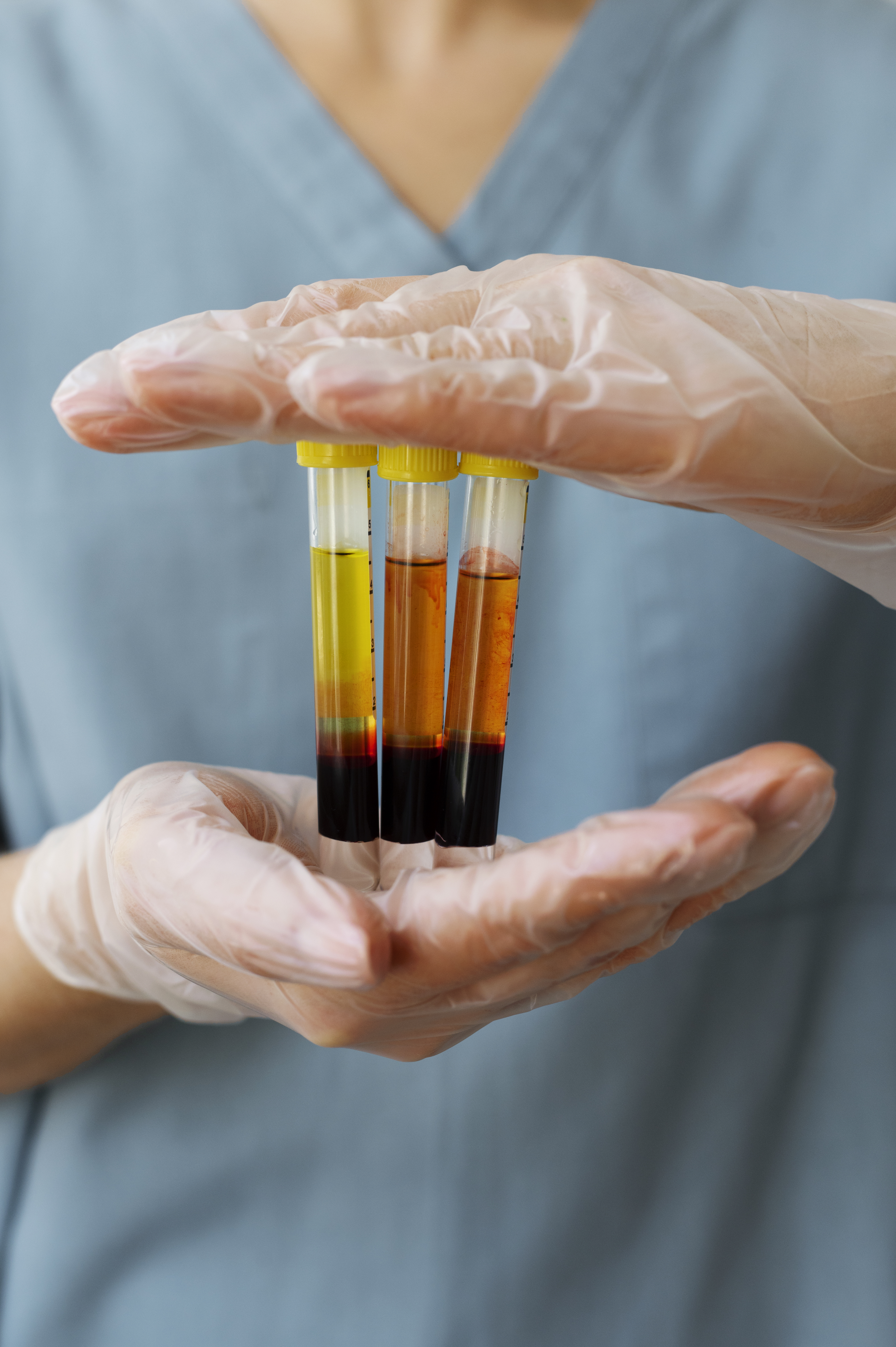 Plasma Rico en Plaquetas